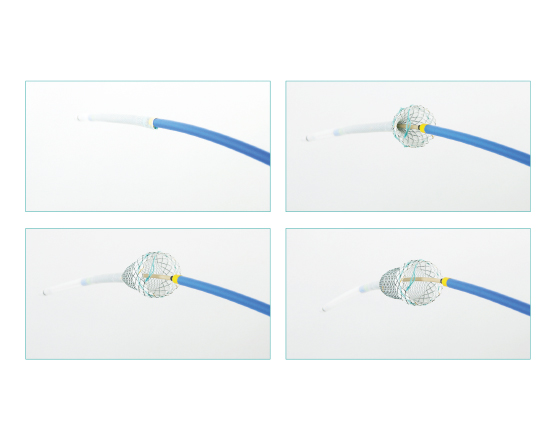 Niti-S Proximal Release Delivery System for Esophageal Stent