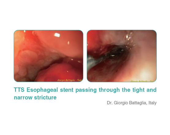Through The Scope (TTS) S Esophageal Stent 1